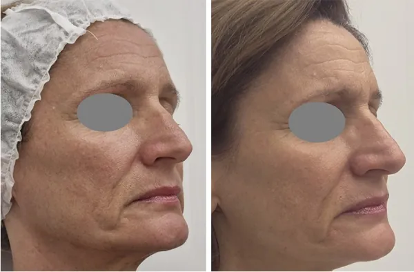 Antes e Depois - Fotona4GLOW™